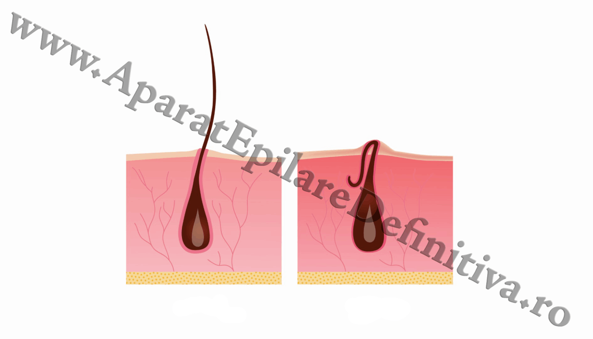 Epilarea cu Laser vindecă Foliculita